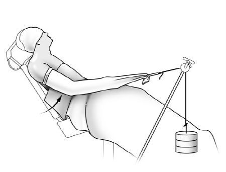 Neurolyse endoscopique du nerf supra scapulaire à l'échancrure coracoïdienne