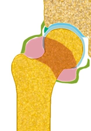 Arthroscopie de hanche avec ouverture de la capsule première ou comment se passer de l'amplificateur de brilliance