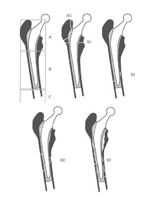 La plaque fémorale anatomique : une solution brestoise pour le traitement des fractures diaphysaires sur implants intramédullaires