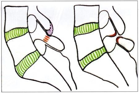 Chirurgie des spondylolyses et des spondylolisthésis