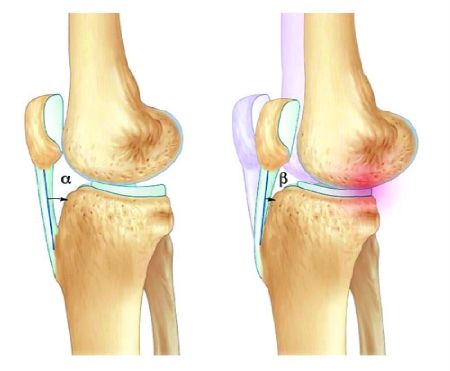 Biomécanique des prothèses totales de genou