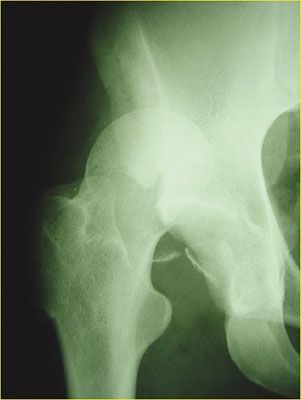 Luxation de hanche sans fracture du cotyle associée : méta-analyses et série de cas rapportés