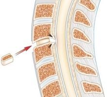 Les cages intervertébrales cervicales : analyse critique de la littérature