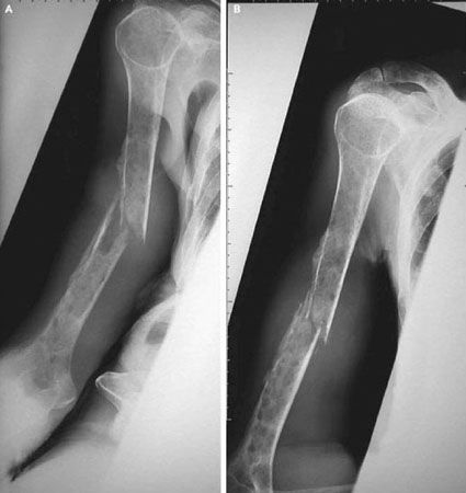 Les nouvelles prises en charge thérapeutiques du myélome en 2008