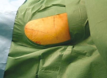 La fixation percutanée dans le traitement des fractures de l'anneau pelvien postérieur