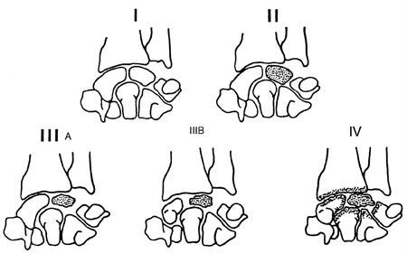 Cimentoplastie du semi-lunaire dans les stades avancés de la maladie de Kienbock
