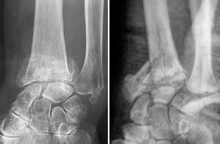 Fractures du radius distal à déplacement dorsal traitées par plaques palmaires : phénomène de mode ou éclair de lucidité ?