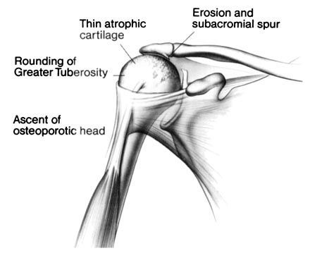 Arthrose par rupture massive de la coiffe des rotateurs