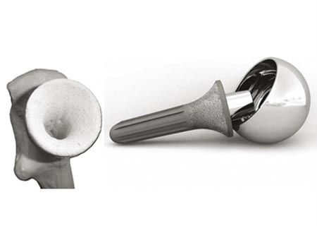 Etude clinique et radiologique de l'implant Birmingham Mid-Head Resection (BHMR) pour résection à mi-tête fémorale