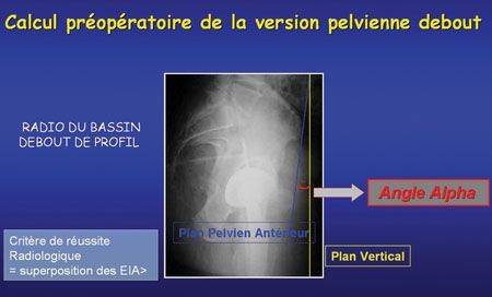 Chirurgie assistée par ordinateur de l’implant acétabulaire dans les prothèses totales de hanche : intérêts, limites et perspectives