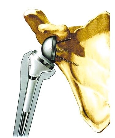 Principes de l'utilisation de la prothèse inversée Bigliani-Flatow