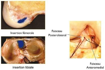 Reconstruction anatomique du ligament croisé antérieur