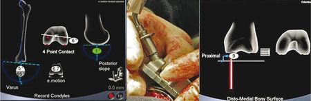 Reprise assistée par ordinateur des prothèses totales de genou : concept et technique opératoire