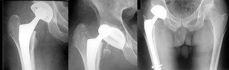 Fractures périprothétiques de la hanche, du genou et de l'épaule