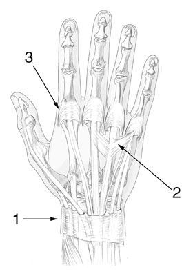 Lésions récentes des tendons extenseurs de la main et des doigts