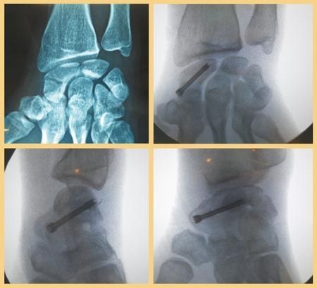 Le vissage percutané rétrograde des fractures non ou peu déplacées du corp du scaphoïde