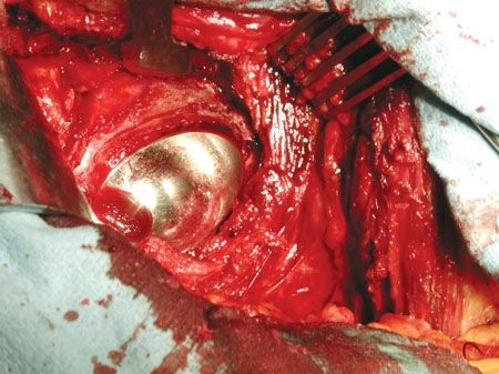 DUROM® : technique opératoire