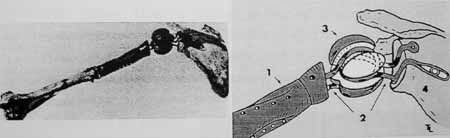 Historique des prothèses d'épaules inversées