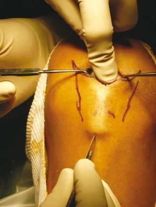 Principes d'utilisation du sampling dans la double voie d'abord pour le prélèvement du tendon patellaire