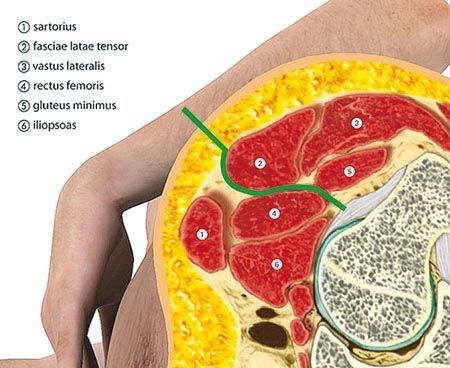 Voie antérieure de type Hueter en décubitus latéral sur table conventionnelle