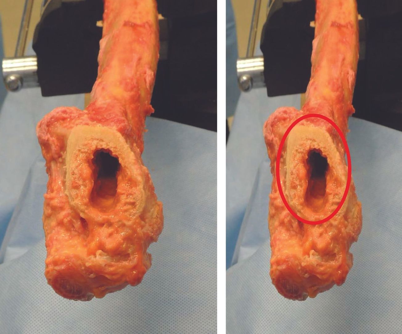 Traitement personnalisé des fractures du col du fémur : le concept de Wiesbaden