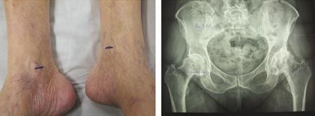 Inégalité de longueur des membres inférieurs après prothèse totales de hanches. Intérêt de la mesure de la résection osseuse