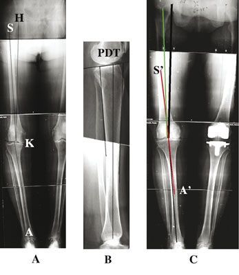 Dégradations rotatoires des genu varum