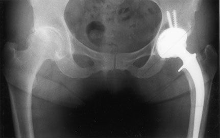 Le couple Alumine-Alumine dans les prothèses totales de hanche : De la théorie à la pratique