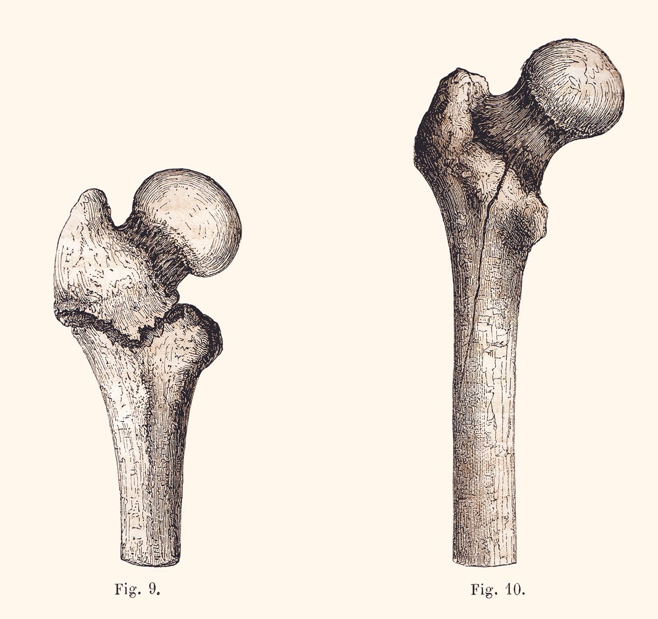 Les fractures du col du fémur en 1880