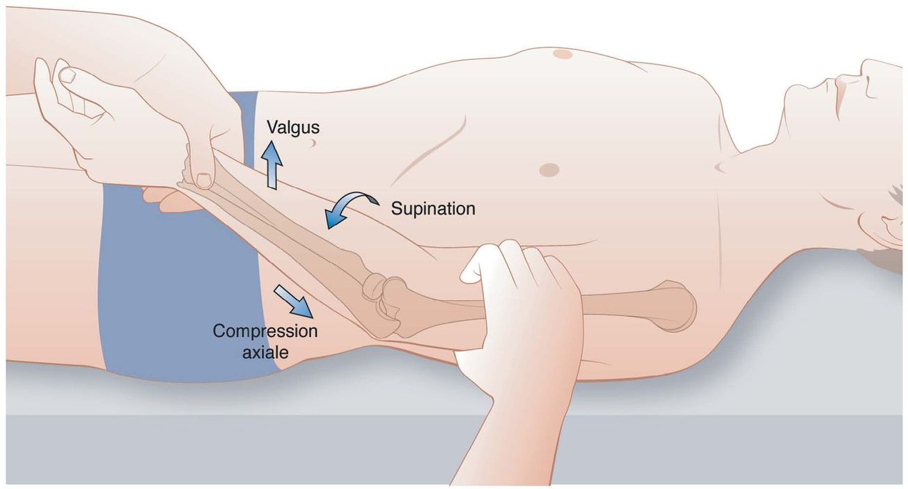 Technique de ligamentoplastie externe de coude