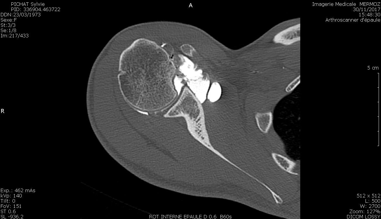 Résultats et facteurs pronostiques  des luxations postérieures de l’épaule