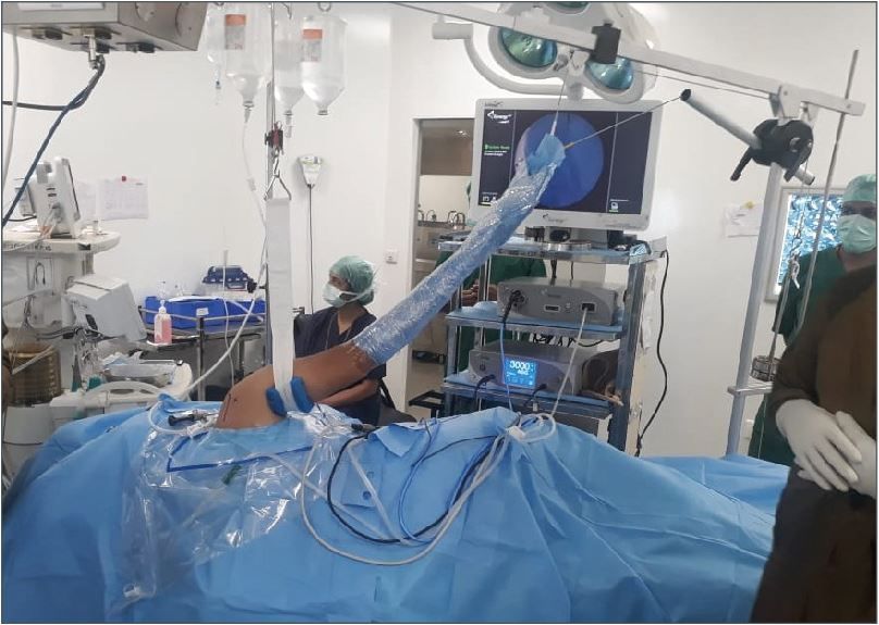 Techniques de réparation de Bankart arthroscopique