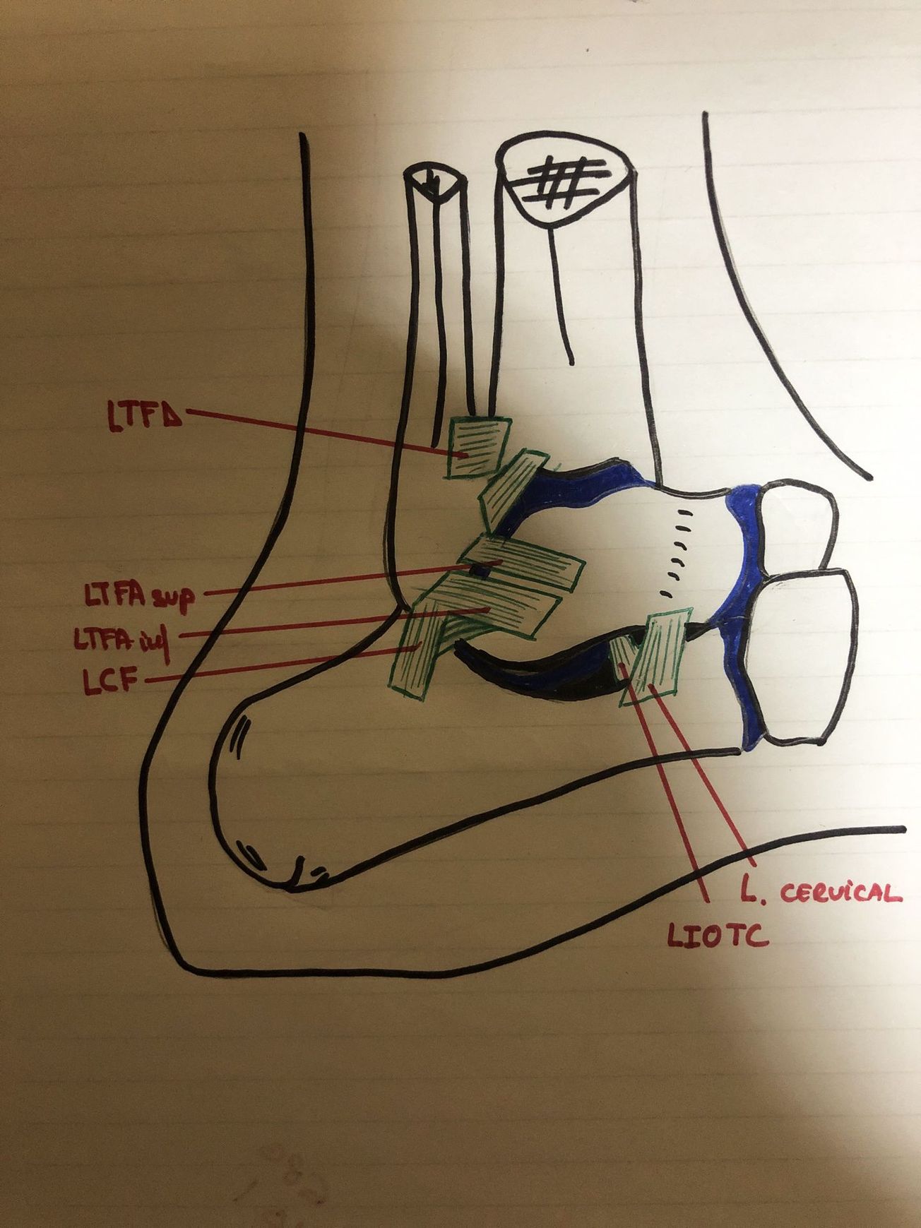 L’instabilité latérale chronique de cheville