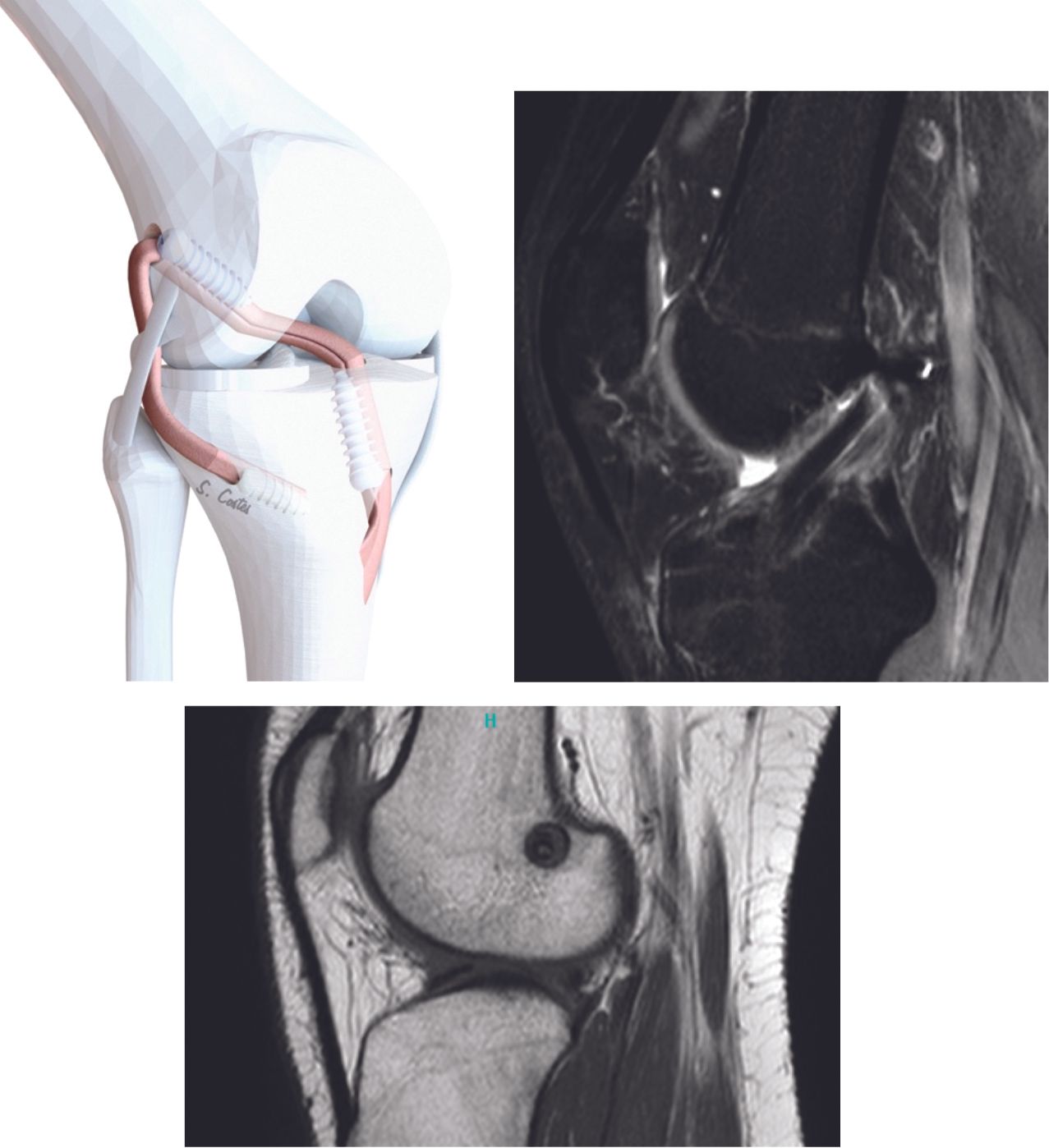 Ligamentoplastie du LCA par une plastie DIDT mixte continue avec plastie latérale originale : description technique et résultats à long terme (10 ans)