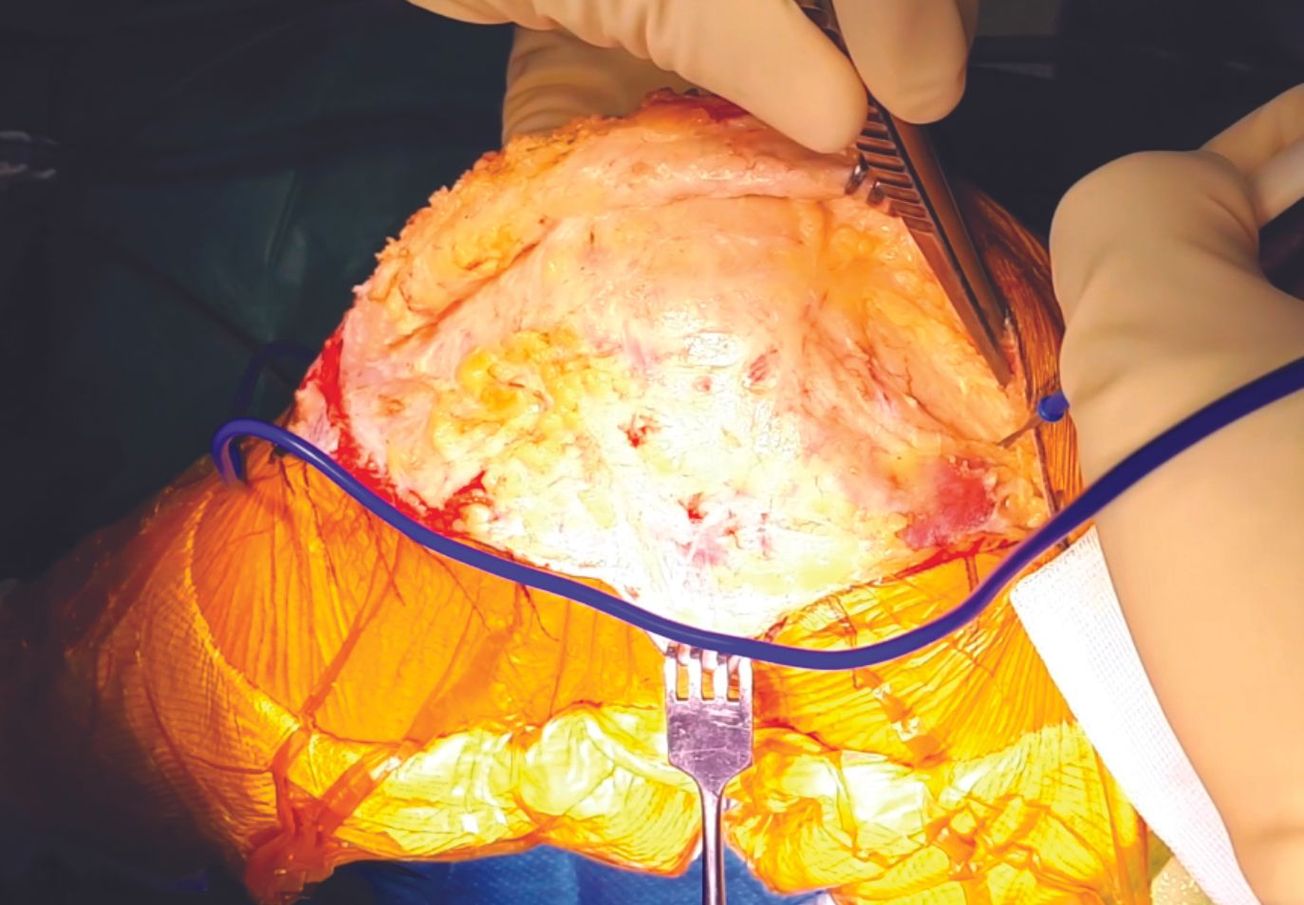 Voie d’abord externe pour une prothèse de genou