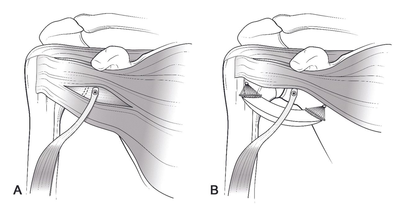 La stabilisation antérieure dynamique (DAS) de l’épaule avec la longue portion du biceps