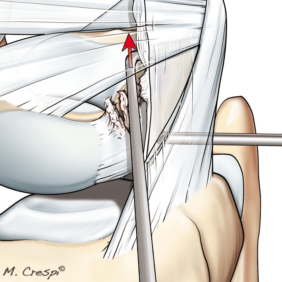 Suture capsulo-ligamentaire dorsale arthroscopique  dans les dissociations scapho-lunaire
