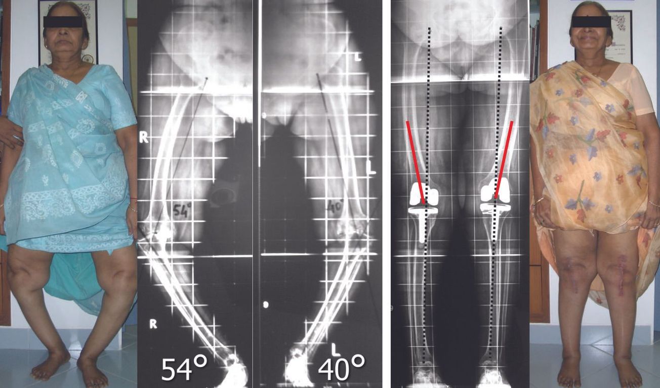 PTG sur genu varum : Modalités illustrées des corrections à effectuer