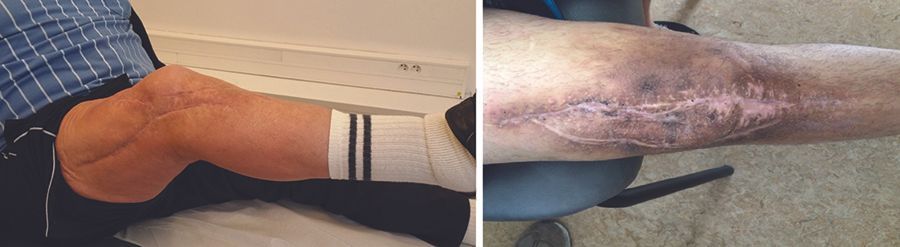 Le débridement dans les infections ostéo-articulaires :  mes principes et ma pratique au quotidien