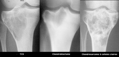 Conduite à tenir devant une tumeur à cellules géantes