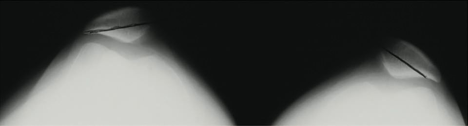 Particularités techniques des prothèses fémoro-patellaires