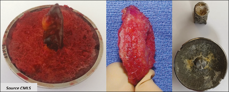 Resurfaçage huméral, l’over-stuffing est-il évitable ?
