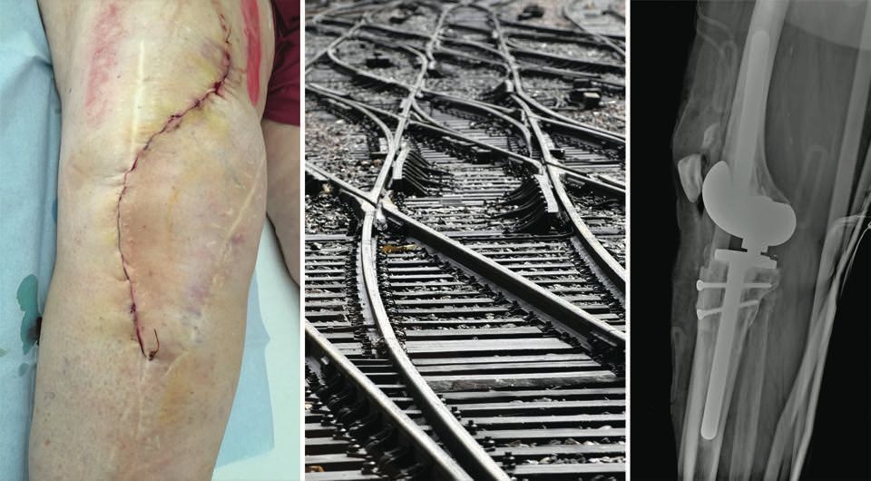 Reprises d’arthroplasties du genou pour faillite mécanique