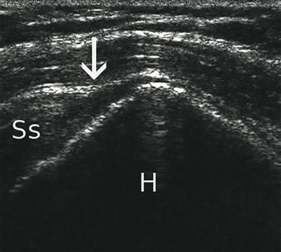 Échographie de l'épaule : Guide à l’usage des chirurgiens de l’épaule.