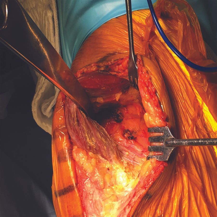 L’abord Subvastus et l’alignement cinématique dans les PTG