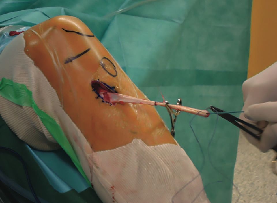 Ligamentoplastie du LCA  aux ischio-jambiers pédiculés et conservation du reliquat ligamentaire