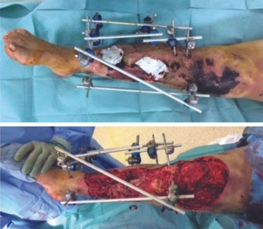 Defects osseux – Infection – Prévention : Prise en charge des infections avec le ciment  aux antibiotiques dans la chirurgie osseuse