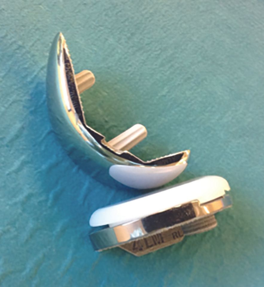 Les indications des prothèses  unicompartimentales du genou : Pourquoi s’imposer des limites ?