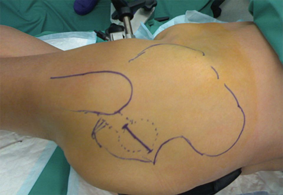 Et si on retournait aux fondamentaux ? Prothèse Totale de Hanche : évolution actuelle  de la voie d’abord postérieure