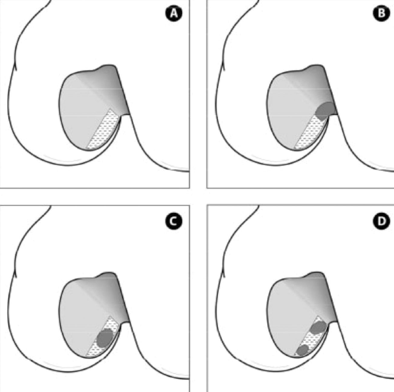 Histoire et tendances actuelles de la chirurgie du ligament croisé antérieur